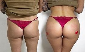 Butt Fillers Before and After
