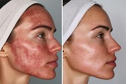 Exosomes Injection for Face & Skin Before & After Dubai & Abu Dhabi