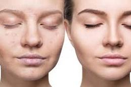 Exosomes Injection for Face & Skin Before & After Dubai