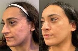 Exosomes Injection for Face & Skin Before & After in Dubai & Abu Dhabi