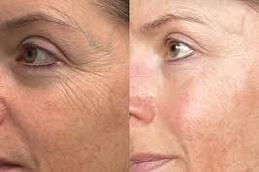 Exosomes Injection for Face & Skin Before & After in Dubai,