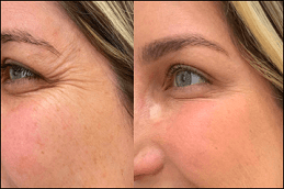 Exosomes Injection for Face & Skin Before & After in Dubai