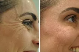 Result of Botox Injections clinic in Dubai