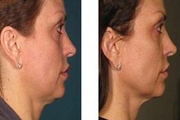 Results OF Best Non-Surgical Facelift for Jowls Dubai & Abu Dhabi