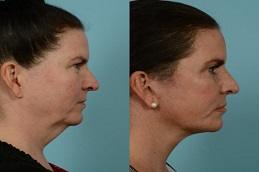 Results OF Best Non-Surgical Facelift for Jowls clinic Dubai & Abu Dhabi