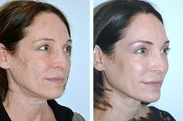 Results OF Best Non-Surgical Facelift for Jowls clinic Dubai