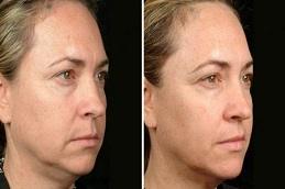 Results OF Best Non-Surgical Facelift for Jowls clinic in Dubai