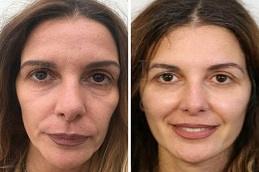 Results OF Best Non-Surgical Facelift for Jowls in Dubai