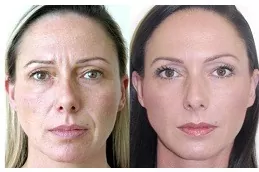Results of Botox Injection clinic in Dubai