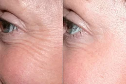 Results of Botox Injections clinic Dubai