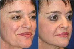 Results of Burn Reconstructive Surgery Clinic Dubai & Abu Dhabi