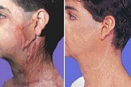 Results of Burn Reconstructive Surgery Dubai & Abu Dhabi
