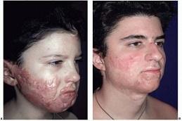 Results of Burn Reconstructive Surgery Dubai