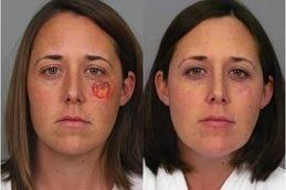 Results of Burn Reconstructive Surgery in Dubai & Abu Dhabi