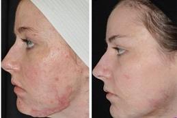 Results of Burn Reconstructive Surgery in Dubai