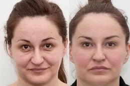 Revolax Dermal Filler Before and after Dubai & Abu Dhabi