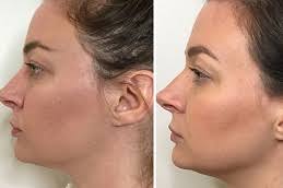 Revolax Dermal Filler Before and after Dubai