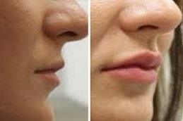 Revolax Dermal Filler Before and after clinic in Dubai