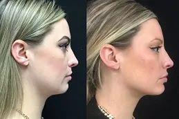 Revolax Dermal Filler Before and after in Dubai & Abu Dhabi