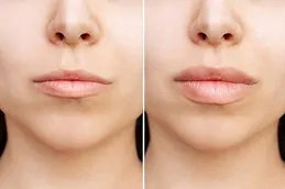 Revolax Dermal Filler Before and after