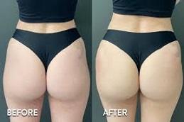 buttock filler before and after clinic Dubai