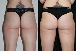 buttock filler before and after clinic in Dubai
