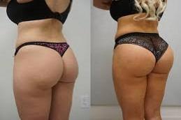 buttock filler injecion before and after clinic Dubai