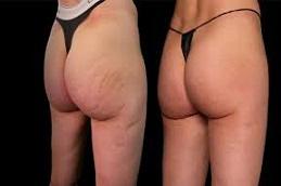 buttock filler injecion before and after clinic in Dubai