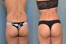 buttock filler injecion before and after in Dubai