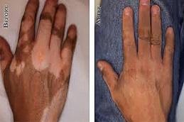 Best Vitiligo Camouflage for Hands Tattoo Before & After