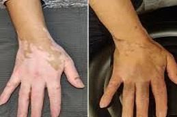 Best Vitiligo Camouflage for Hands Tattoo Before & After,
