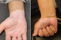 Best Vitiligo Camouflage for Hands Tattoo Before & After Dubai