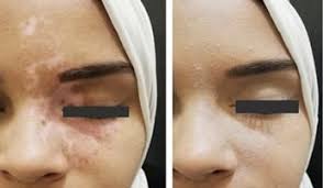 Best Vitiligo Camouflage for Hands Tattoo Before & After Dubai