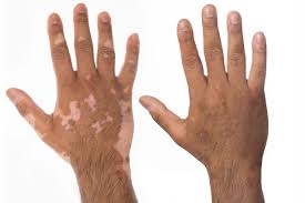 Best Vitiligo Camouflage for Hands Tattoo Before & After in Dubai