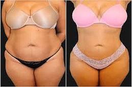 Bodytite Liposuction Before & After clinic in Dubai ,