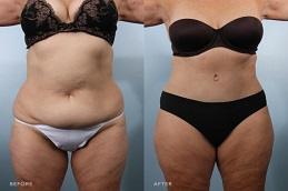 Bodytite Liposuction Before & After clinic in Dubai