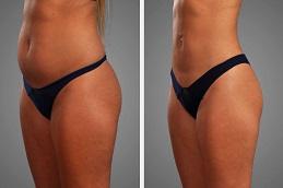 Bodytite Liposuction Before & After clinic in Dubai,