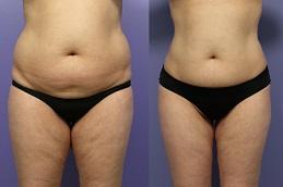 Bodytite Liposuction Before & After in islamabad