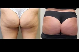 Butt Filler Before & After Dubai,