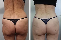 Butt Filler Before & After clinic Dubai