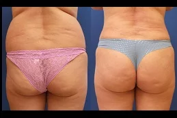 Butt Filler Before & After in Dubai,