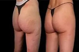 Butt Filler Before & After in Dubai