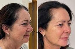 Endolift Before and After Dubai & Abu Dhabi