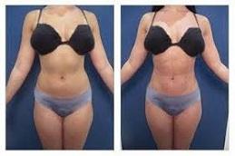 High Definition Liposculpture Before & After Dubai,
