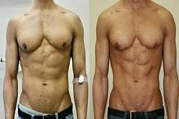High Definition Liposculpture Before & After Dubai & Abu Dhabi