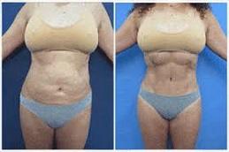 High Definition Liposculpture Before & After Dubai