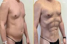 High Definition Liposculpture Before & After clinic Dubai & Abu Dhabi