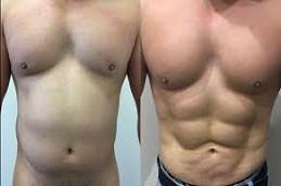 High Definition Liposculpture Before & After in Dubai