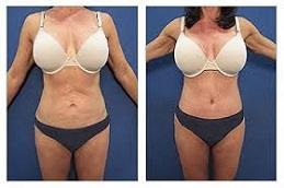 High Definition Liposculpture clinic Before & After Dubai