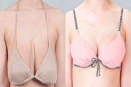 How to Choose the Right Breast Augmentation Implants Before & After,